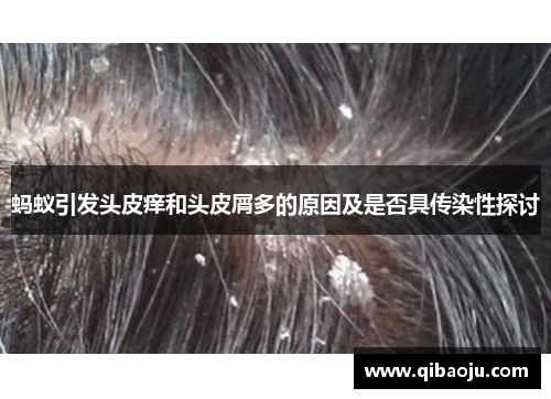 蚂蚁引发头皮痒和头皮屑多的原因及是否具传染性探讨